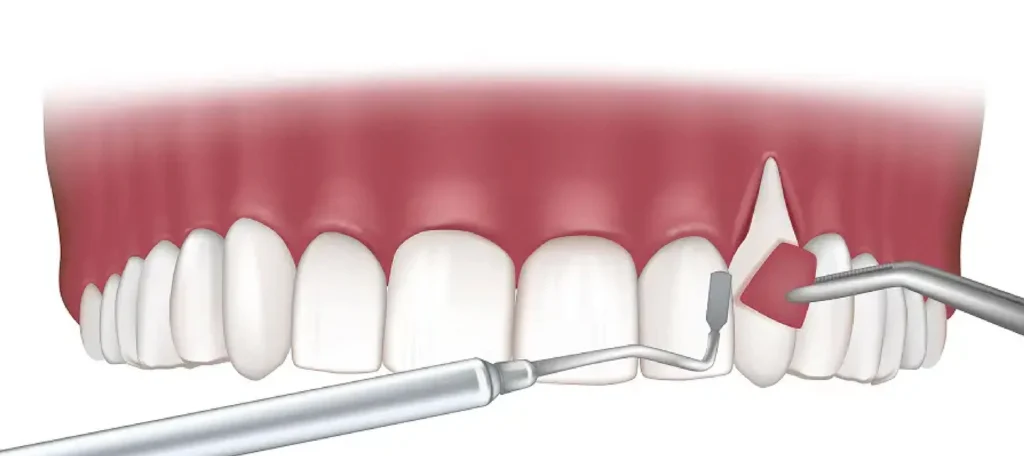 gum graft