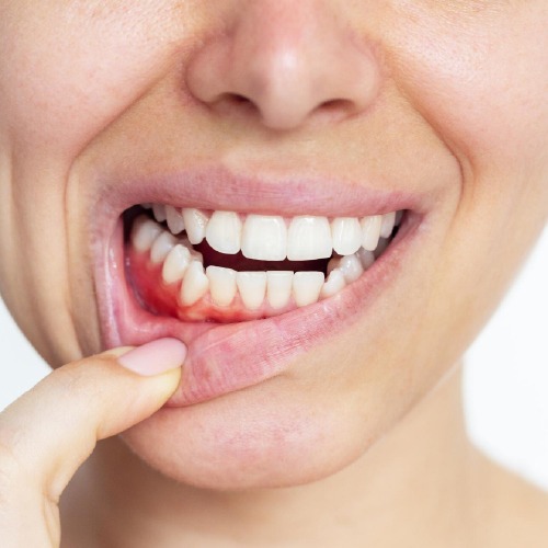 gum graft