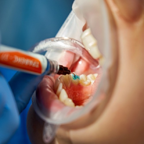 deep cleaning teeth