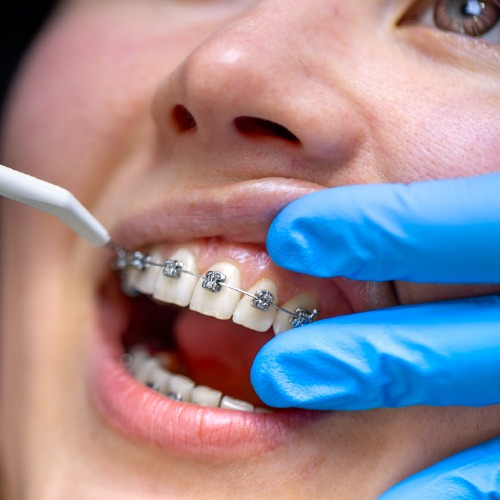 dental braces for adults