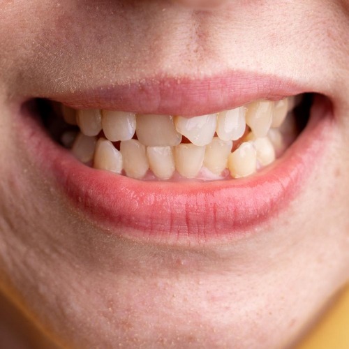 misaligned teeth