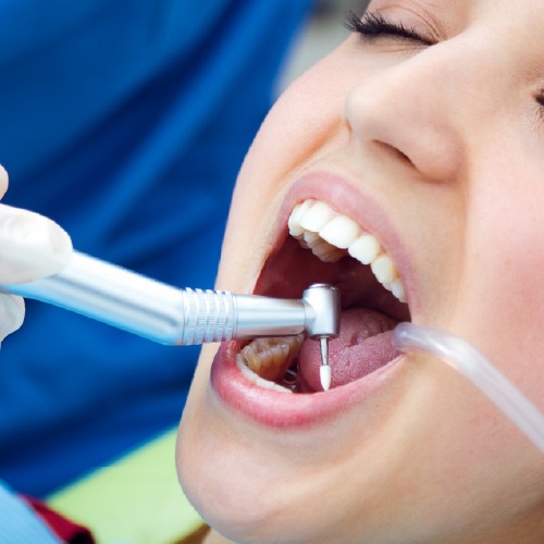 deep tooth cleaning