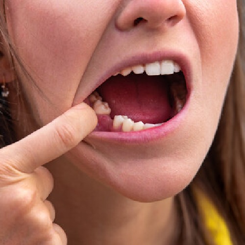 best solution for missing teeth