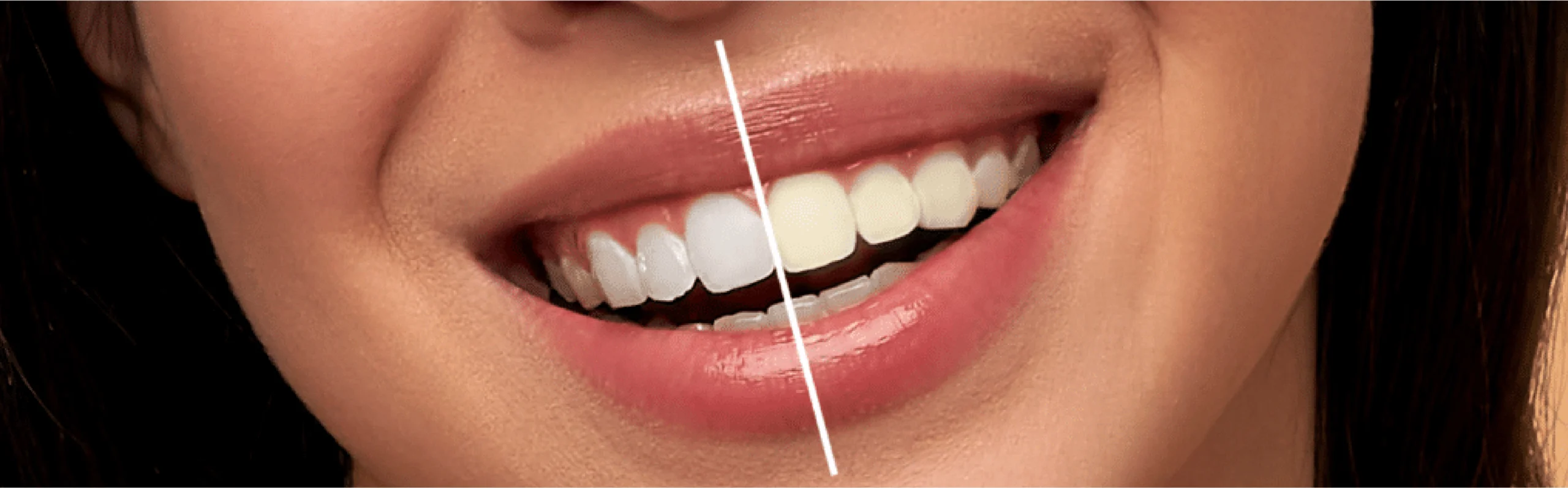 professional teeth whitening