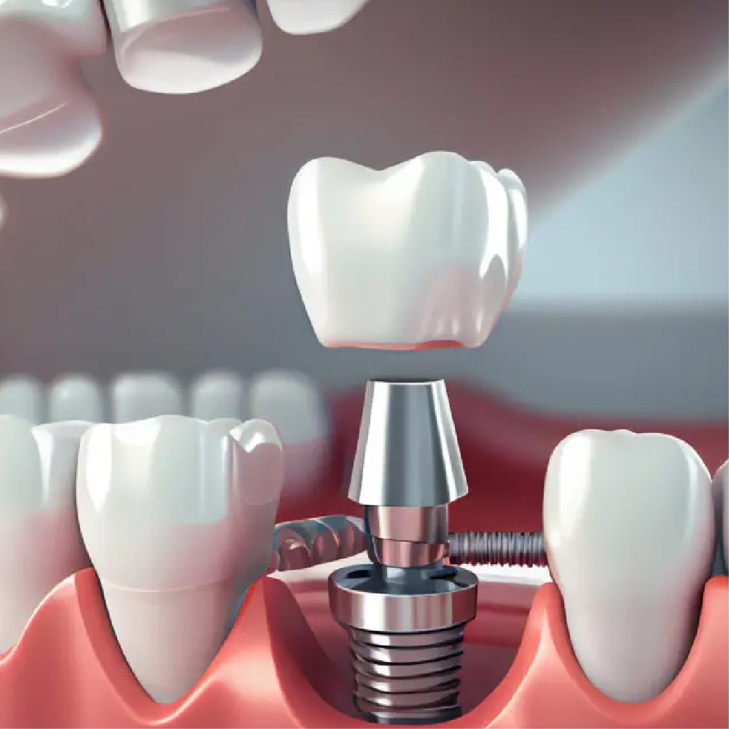 benefits of dental implants