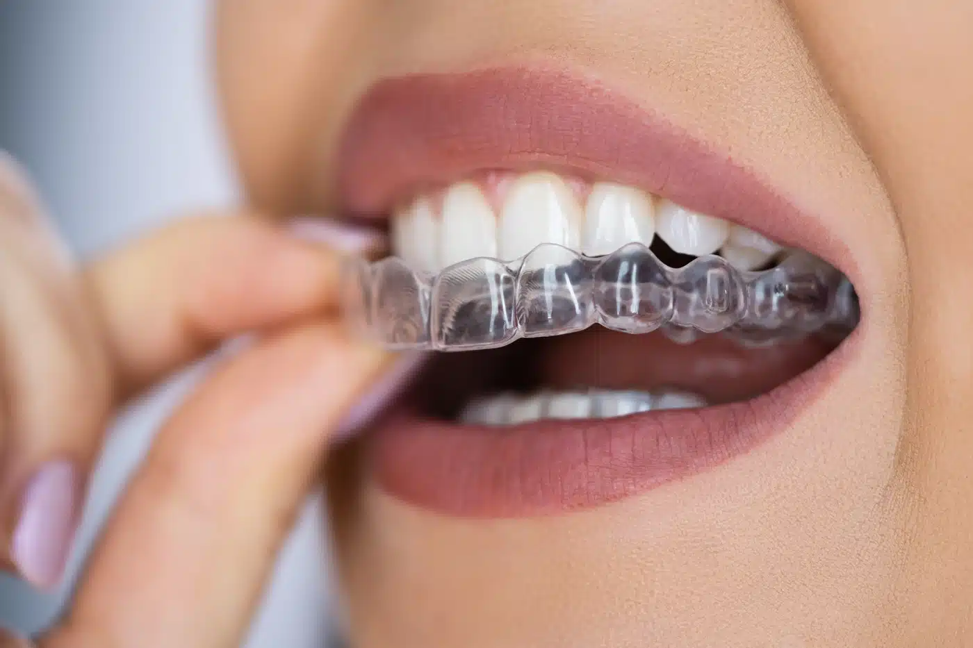best clear aligners​