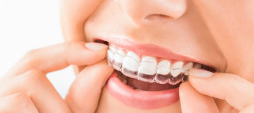 Your Guide to Teeth Straightening Invisalign - The Grace Dental