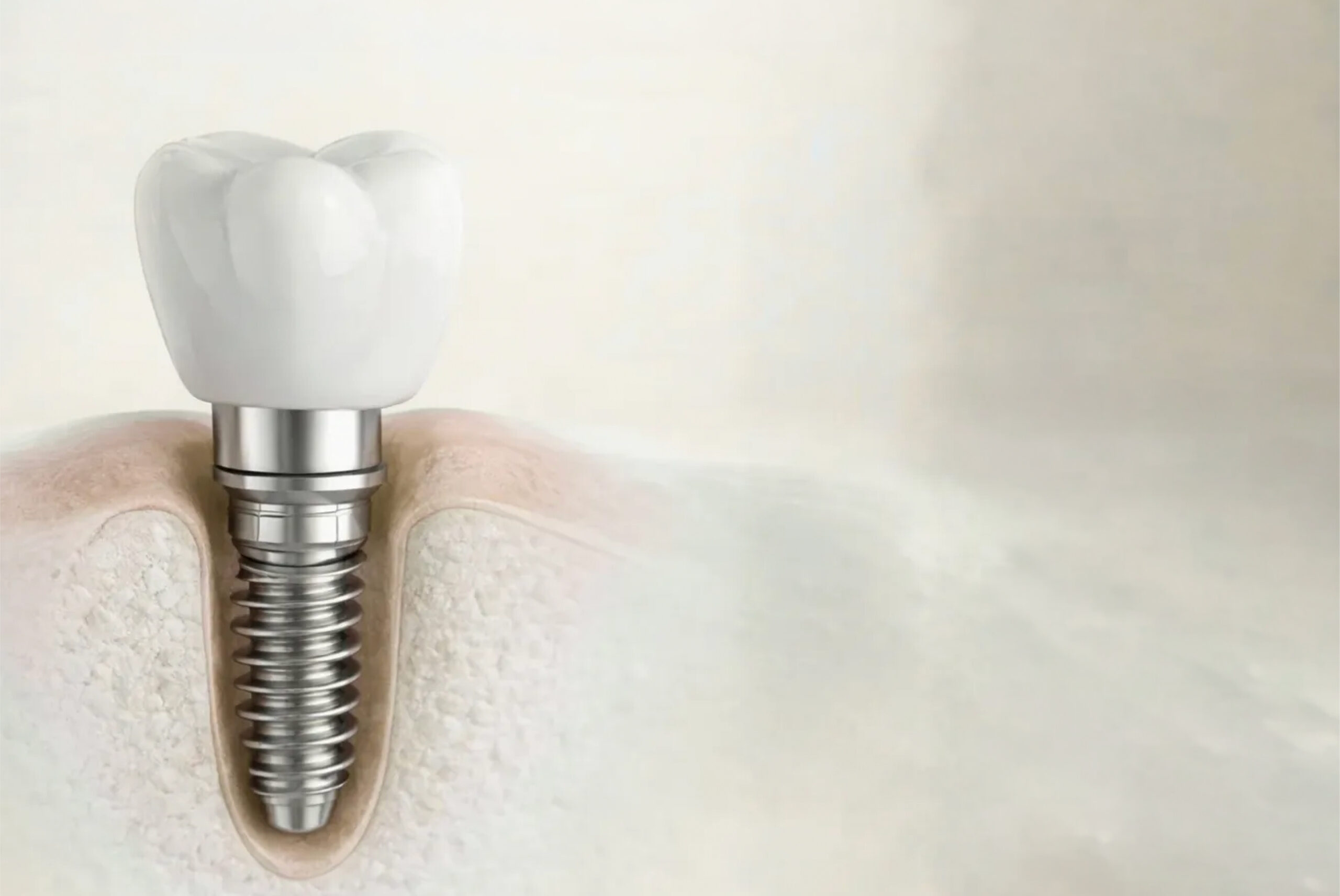 implant restoration​