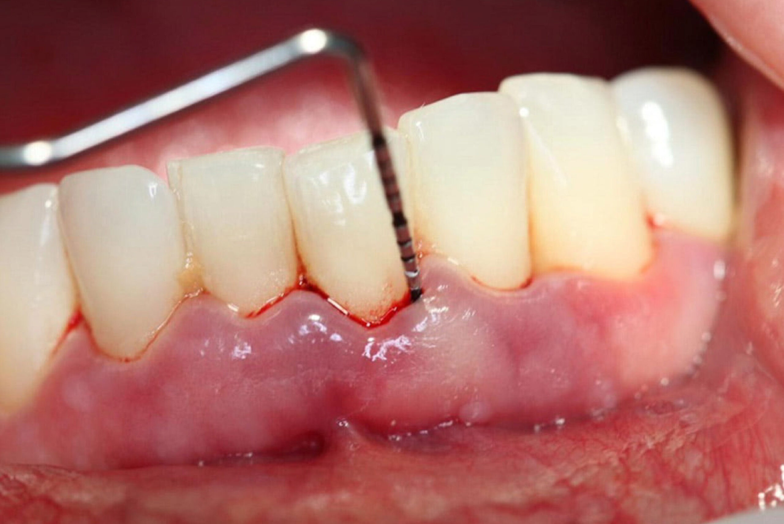 deep teeth cleaning