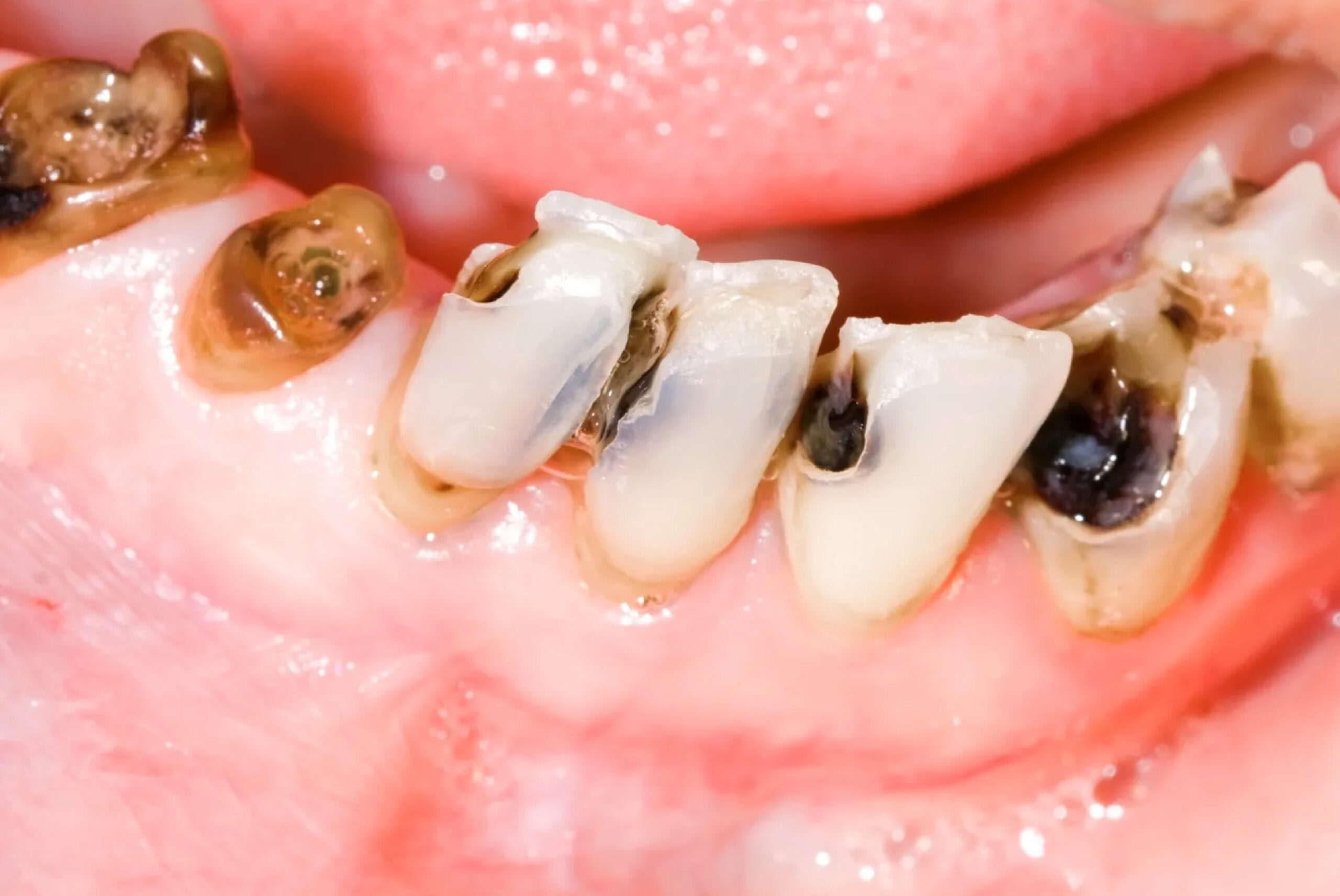 tooth cavity filling