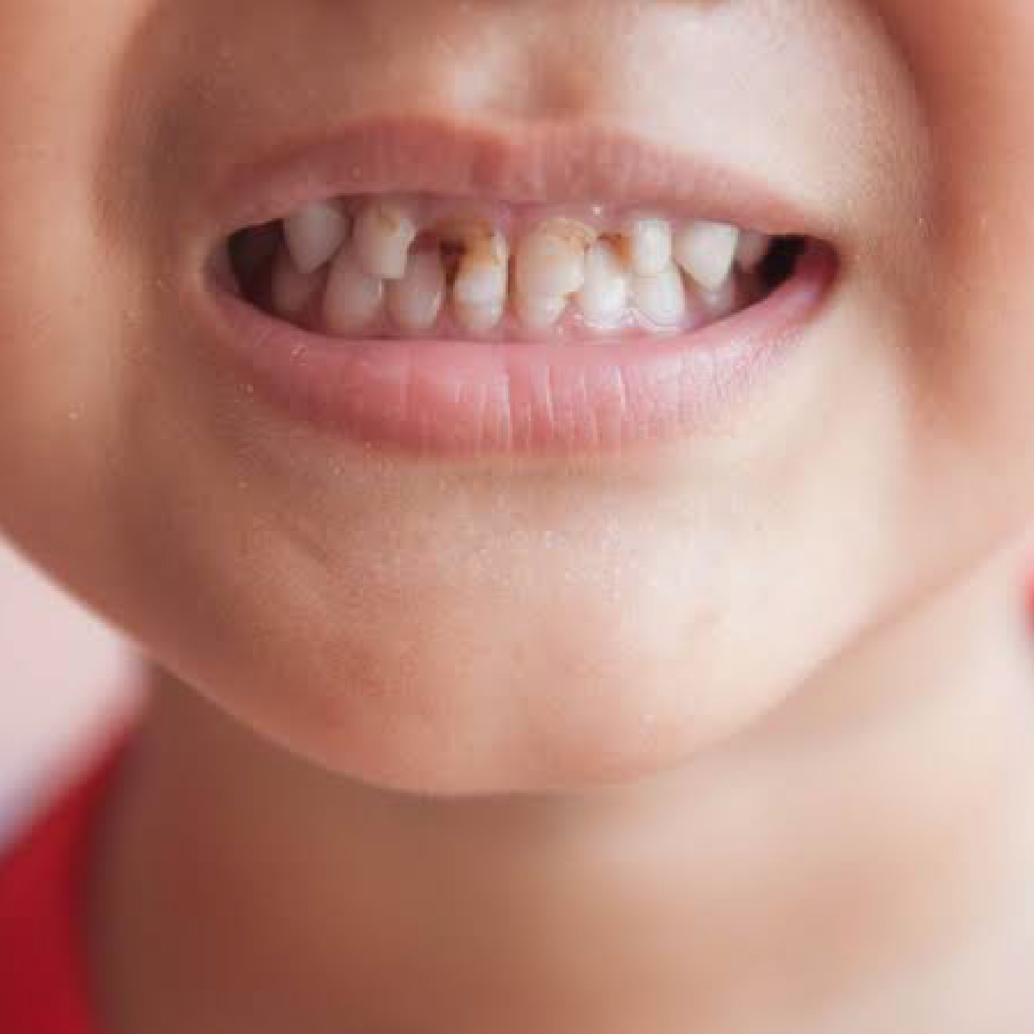 child tooth decay