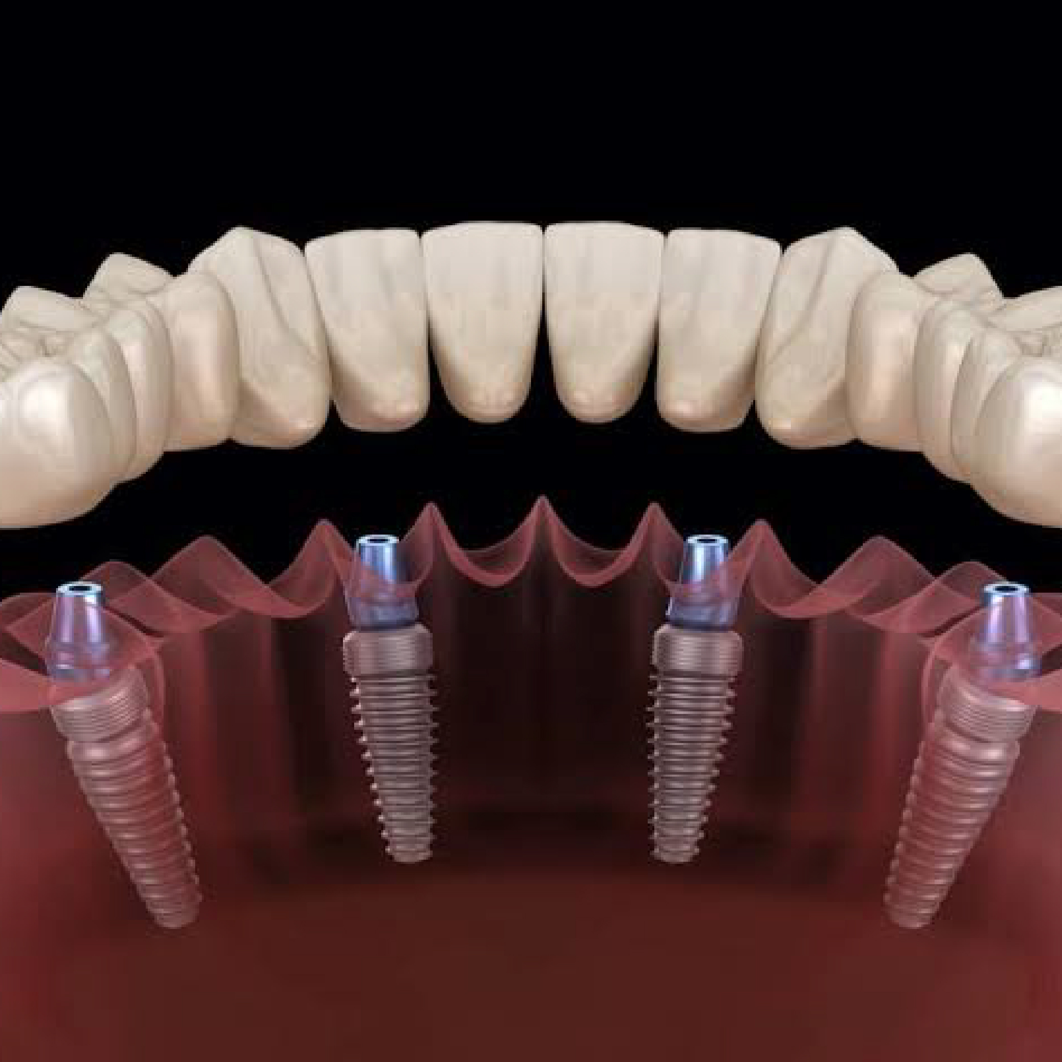 Dental Implants