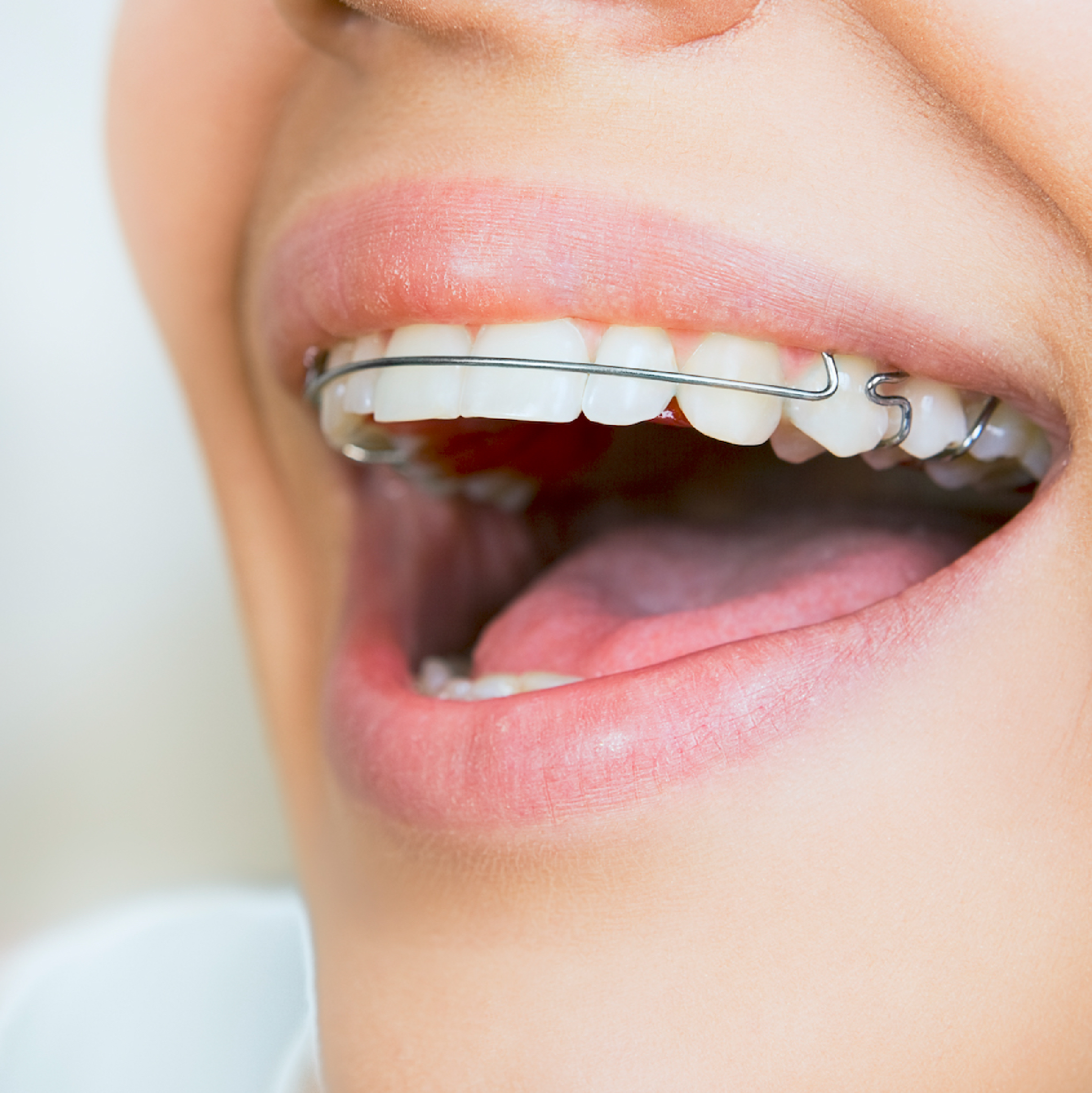 teeth retainer