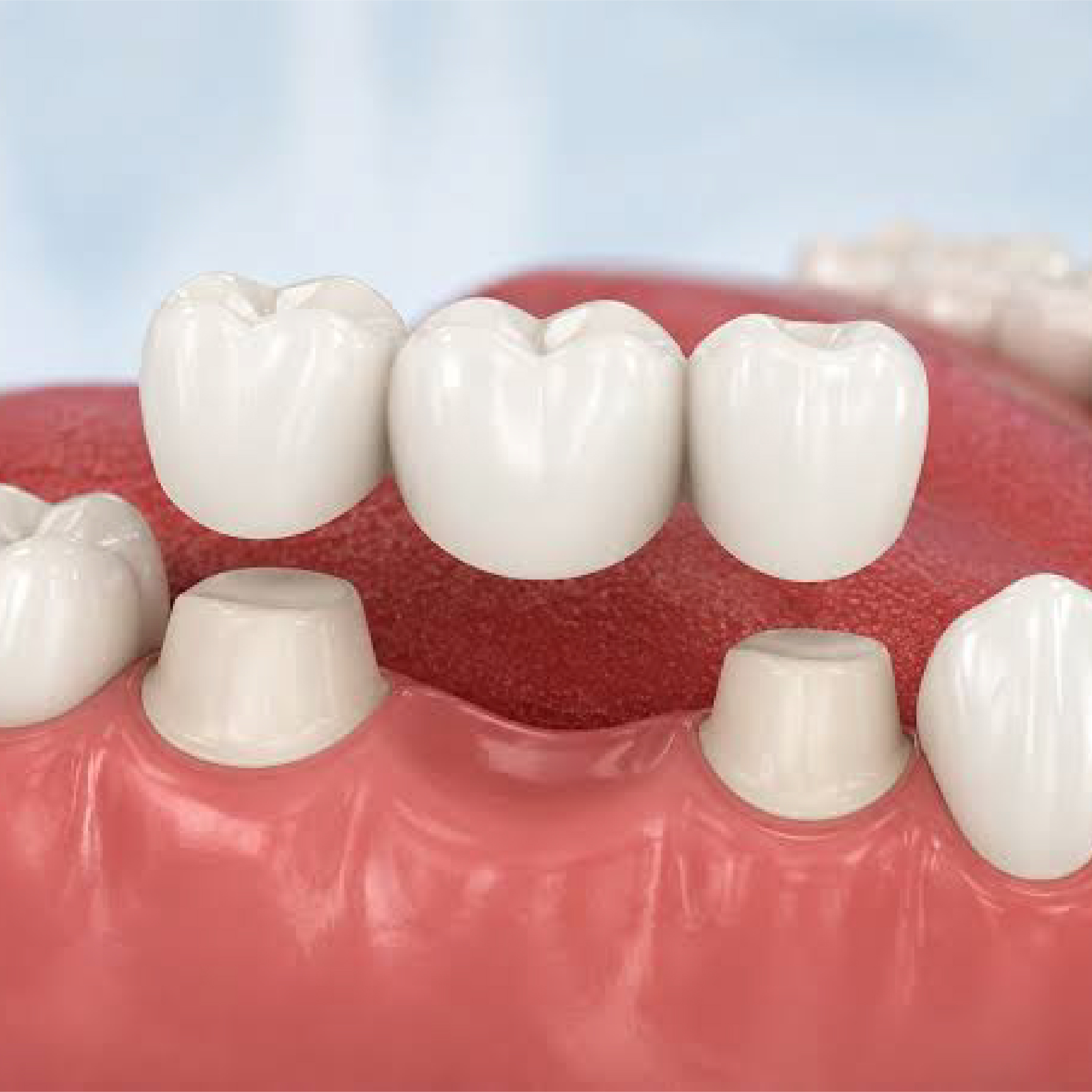 types of bridges for teeth