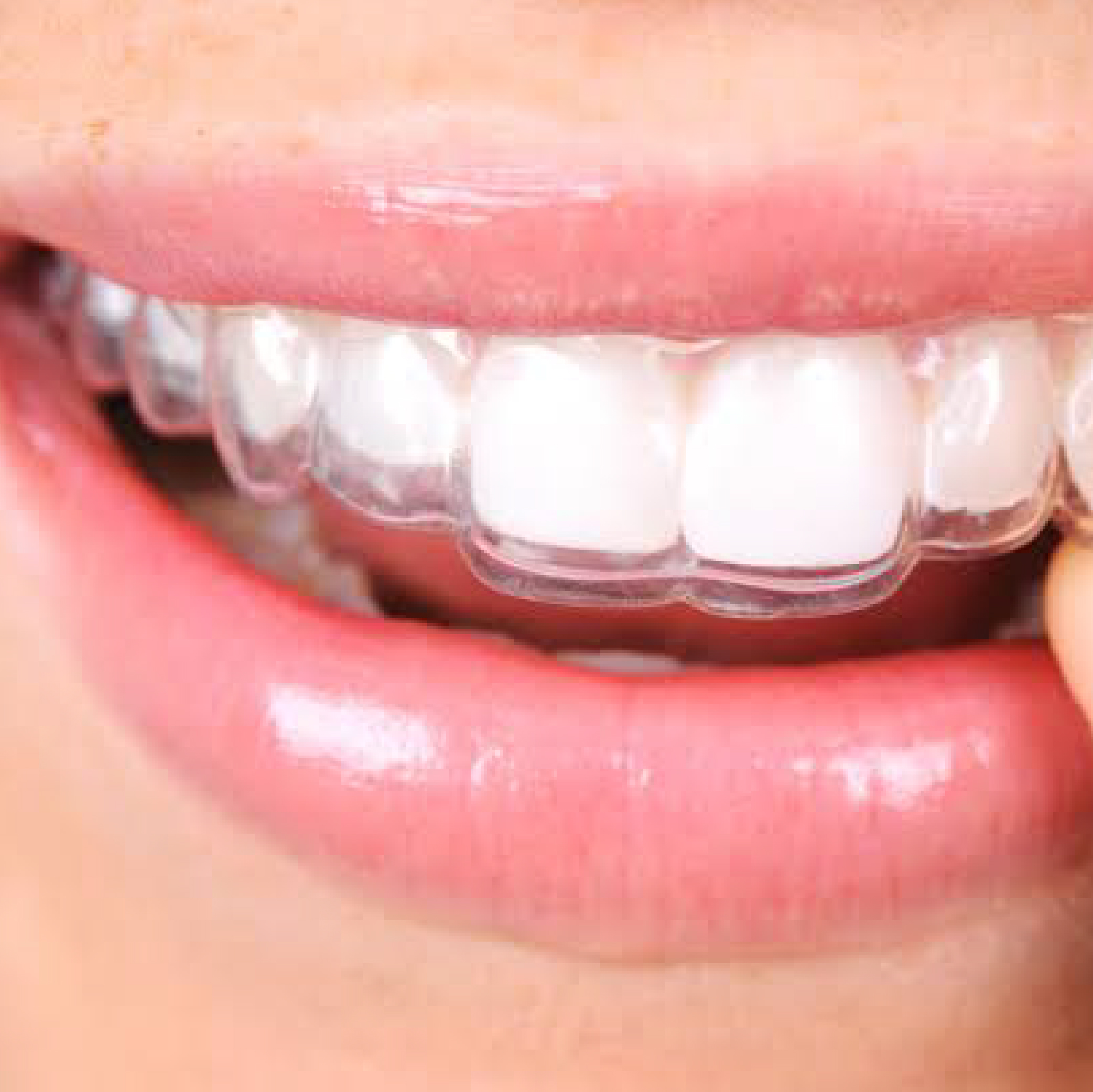 retainers after braces​