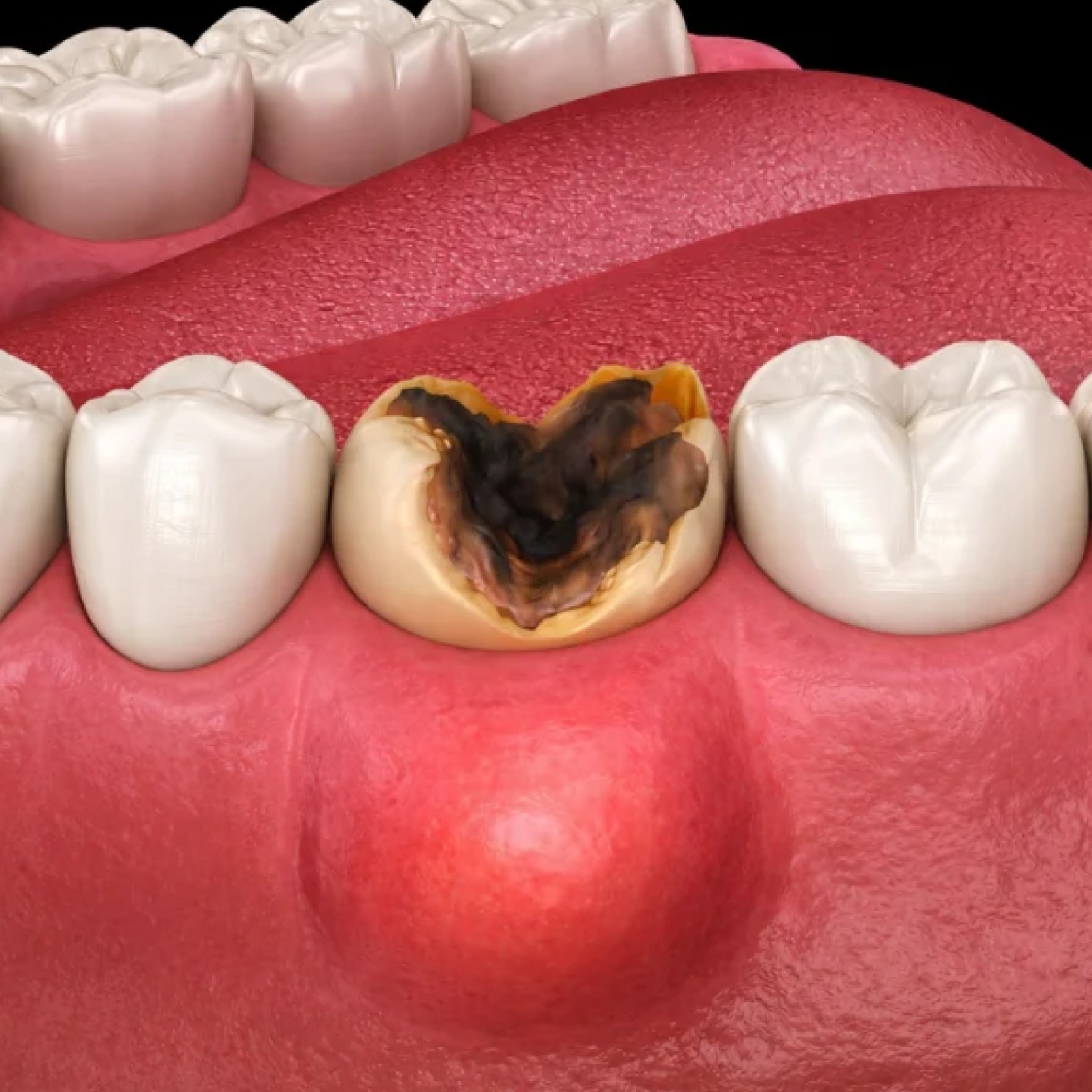 untreated tooth infection